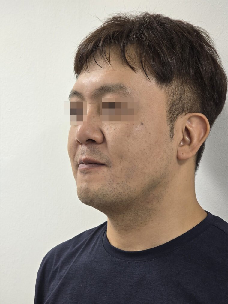 고명효-비포